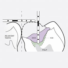 Example clinical illustration of a tooth
